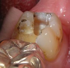 Schmerzhafter Haarri�, mit Amalgam beschwerdefrei