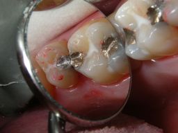 1 frische, 2 �ltere F�llungen, Fissurenversiegler