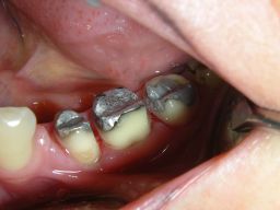 Z�hne mit Amalgamf�llungen f�r Kronen vorbereitet