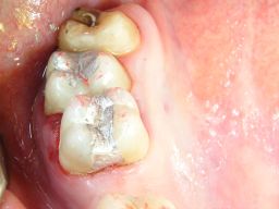 Mittelgro�e und gro�e Amalgamf�llung